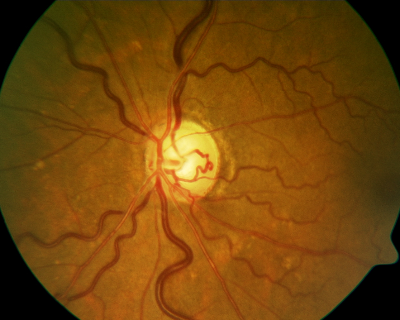 KMK Optometry Pro on Instagram: “At first glance, this optic nerve may  appear normal. However, this is a case of double ring sign seen in a  patient with optic n…